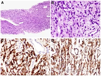 美国癌症全基因检测成功治疗软组织肉瘤