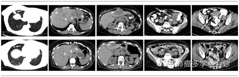 MET抑制剂治疗MET14外显子跳跃突变肺癌有惊人疗效