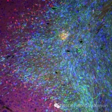 【脑瘤专栏】临床试验取得重大突破，可使致死性脑瘤停止生长