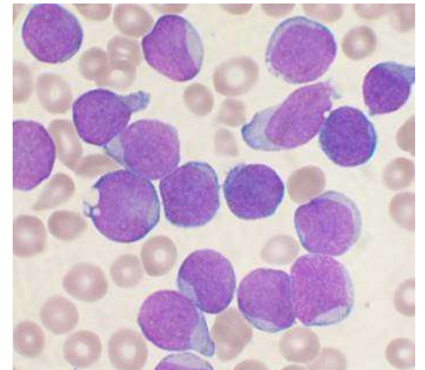 世纪之争终于尘埃落定！科学家首次发现儿童白血病诱因