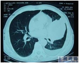 世界第一台速锋刀可有效治疗中心型肺癌