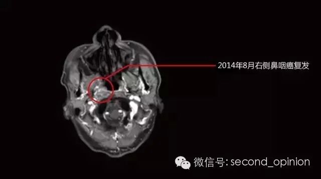 52岁鼻咽癌患者接受RPTC质子治疗