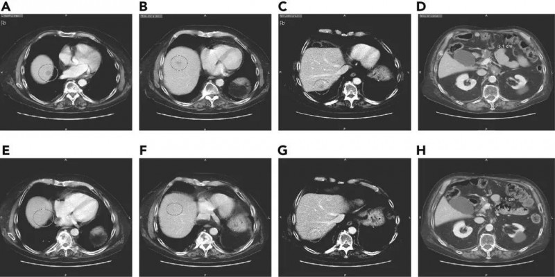 胰腺癌治疗,胰腺癌新疗法、新技术、新治疗方案让患者生存期翻倍