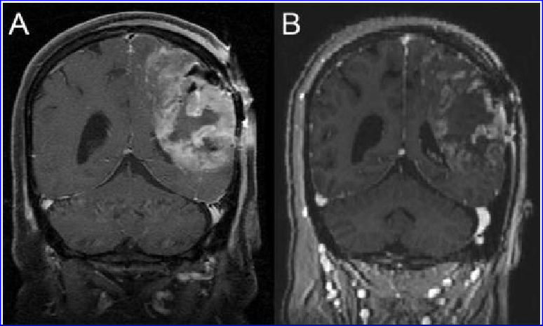 溶瘤病毒治疗胶质母细胞瘤效果