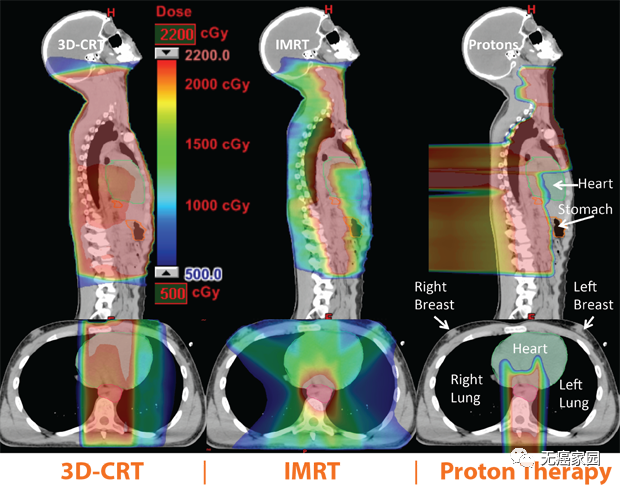 恶性淋巴瘤放疗,质子治疗淋巴瘤二次患癌风险减少50%