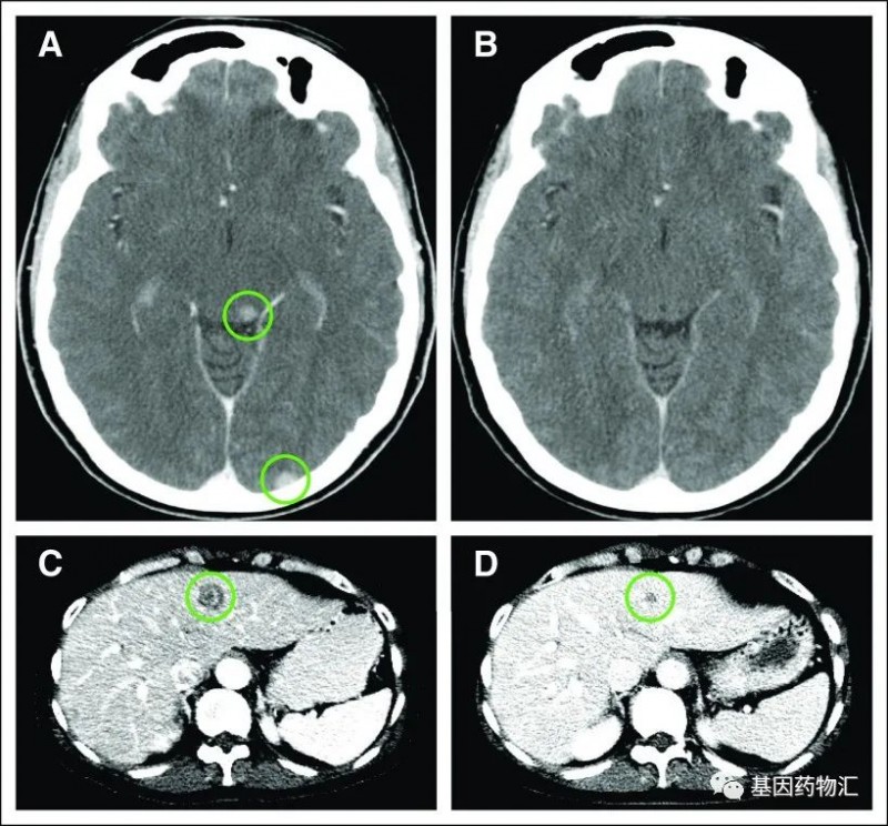 乳腺癌NTRK基因融合突变,NTRK抑制剂治疗后全身病灶缩小过半、脑转移病灶全部消失