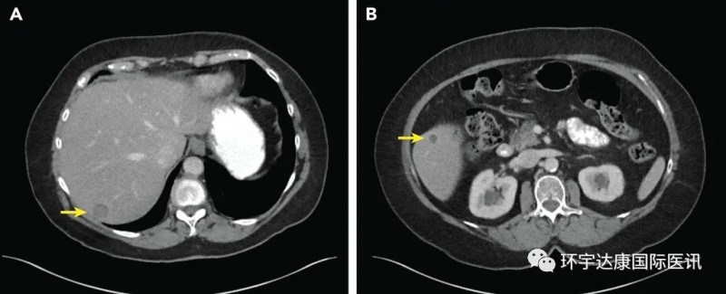 肉瘤靶向治疗,肉瘤靶向药物拉罗替尼挽救手术、放化疗、靶向无效陷入绝境的患者