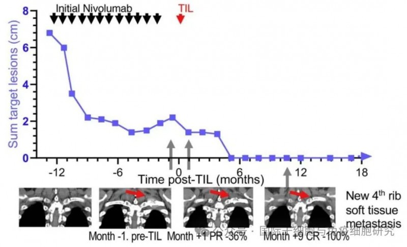 TIL细胞疗法治疗转移性非小细胞肺癌的效果