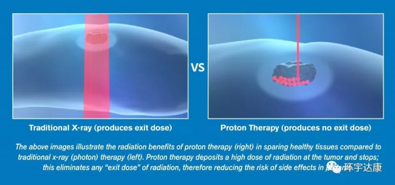 传统放疗和质子放疗