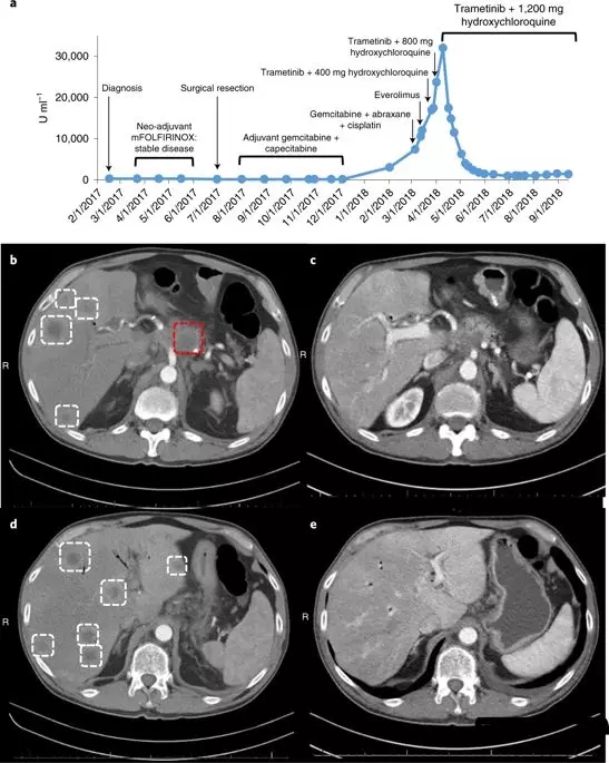 氢氯喹联合曲美替尼治疗胰腺癌的效果和数据