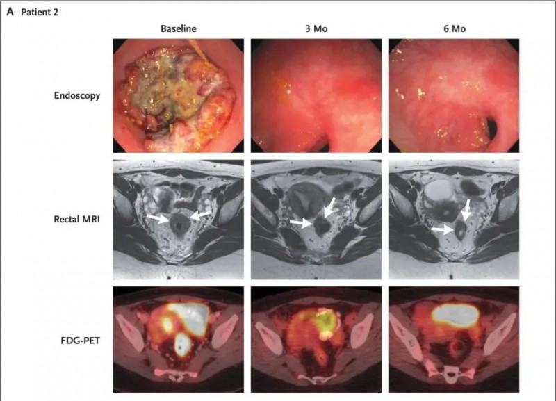 结直肠癌新药新疗法无需化疗就能100%缓解