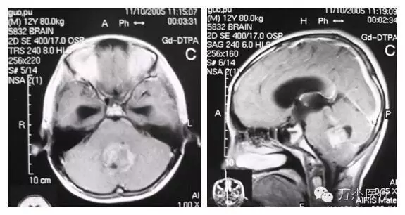 髓母细胞瘤用传统放疗好还是质子放疗好？