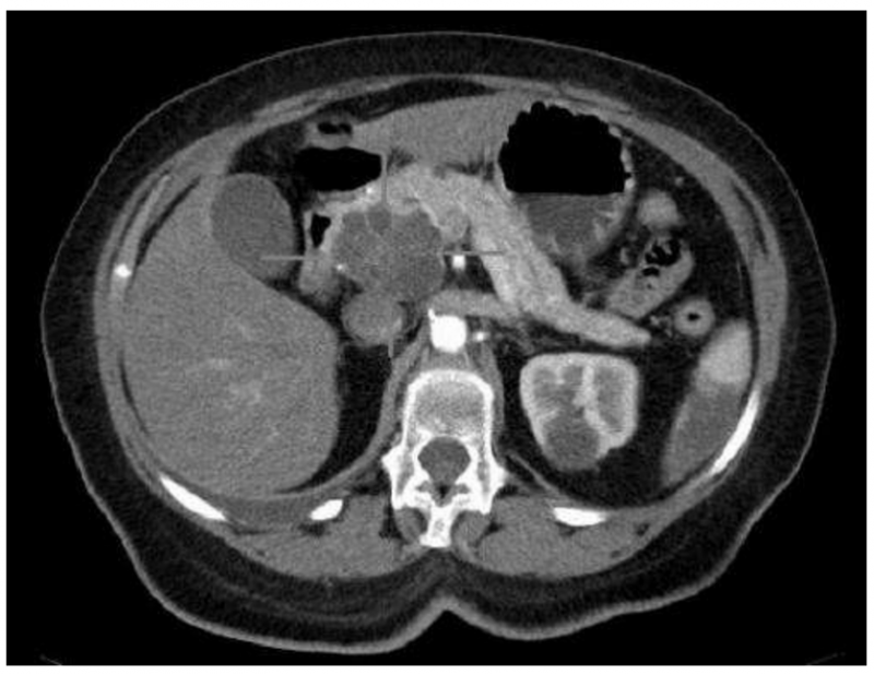 Don’t worry！胰腺癌患者体重下降快  但不影响总体生存