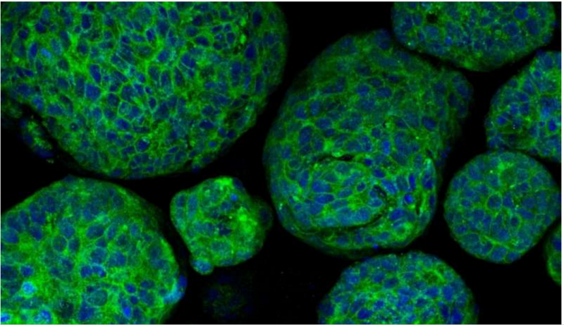 体外培养的微型肿瘤助力罕见前列腺癌个性化治疗