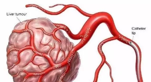 晚期肝癌患者别蓝瘦、别香菇：钇90微球体放射治疗给您希望