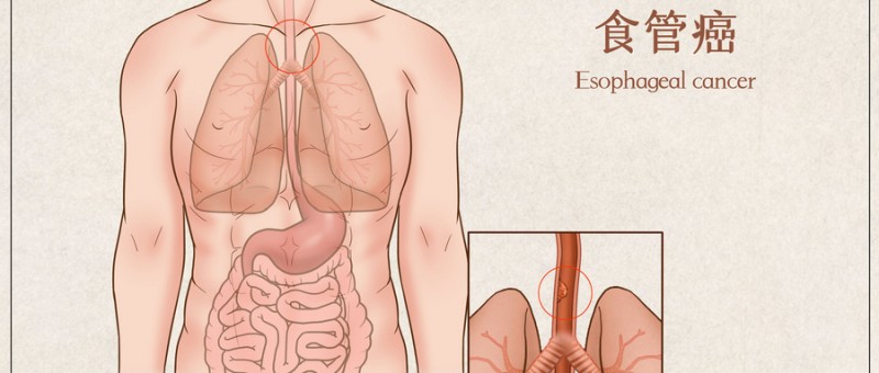 食管癌质子治疗让82岁的患者肿瘤完全消失,质子治疗食道癌到底有什么优势