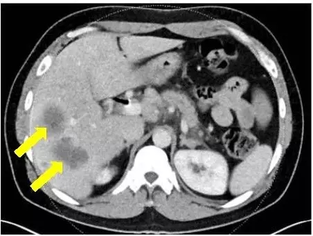 胰腺癌确诊是影像图