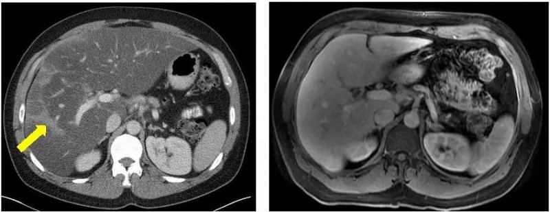 奥拉帕尼治疗后的胰腺癌影像图