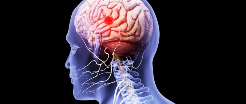 质子治疗脑瘤效果怎么样