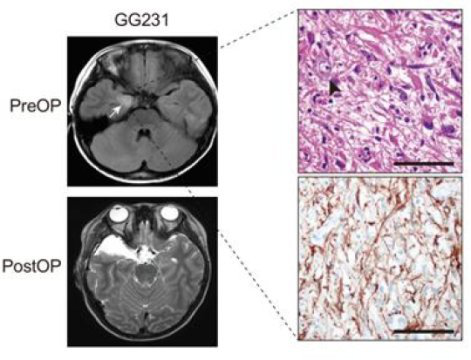 科学家发现儿童肿瘤引发顽固性癫痫的新治疗靶点