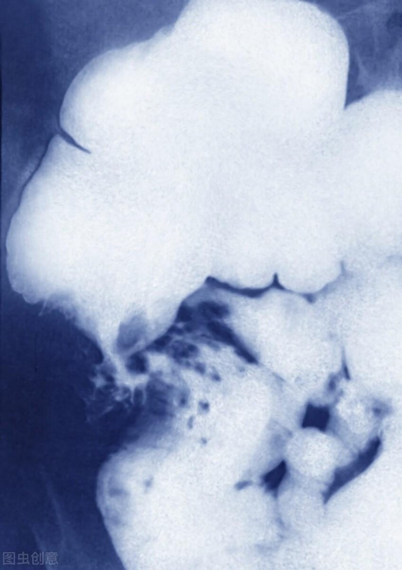 结直肠癌晚期抗癌成功案例