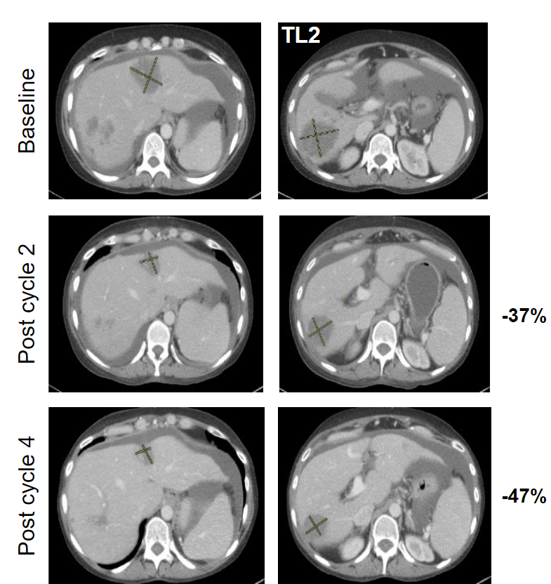KRASG12C靶向药Adagrasib(MRTX849)治疗结直肠癌患者的肿瘤缩小近50%