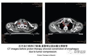 食道癌质子治疗,89岁高龄不能手术、不能化疗的患者,一年后无肿瘤迹象