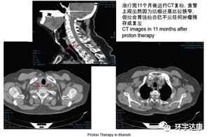 食道癌质子治疗后CT影像