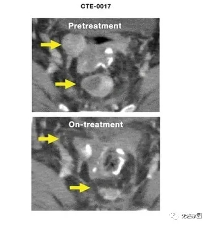 树突疫苗治疗卵巢癌经过几周前后对比