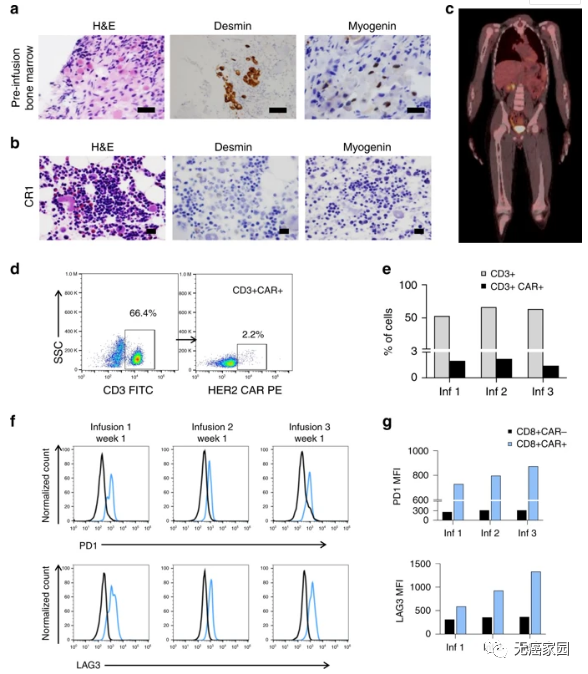 7岁的复发难治性横纹肌肉瘤患儿CAR-T治疗案例