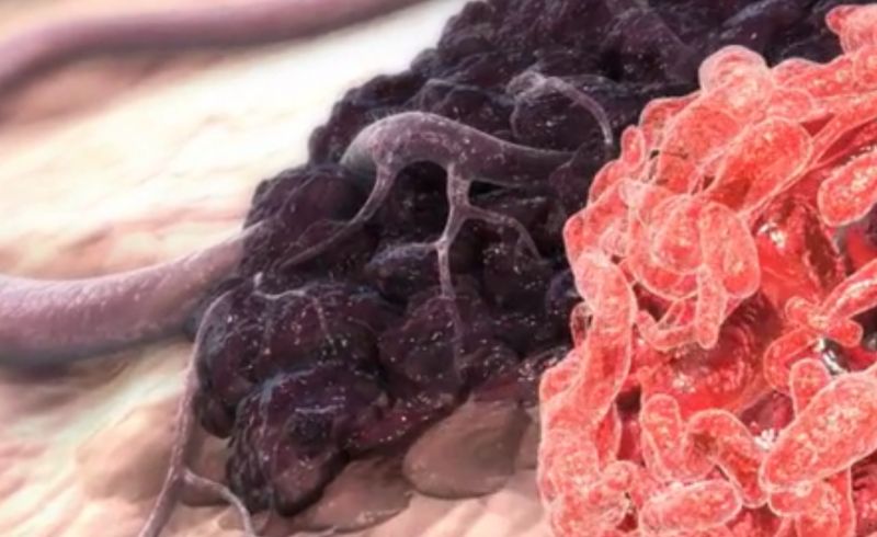 为什么吃槟榔会得口腔癌,如何避免得口腔癌