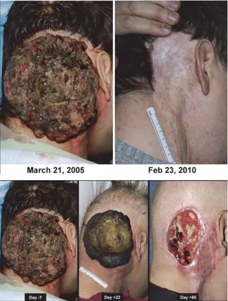 后颈部真菌性肿瘤