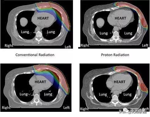 乳腺癌放疗,随访8年几乎无复发,乳腺癌短期高强度放疗与标准放疗效果一样