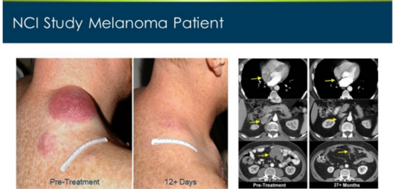 恶性黑色素瘤患者