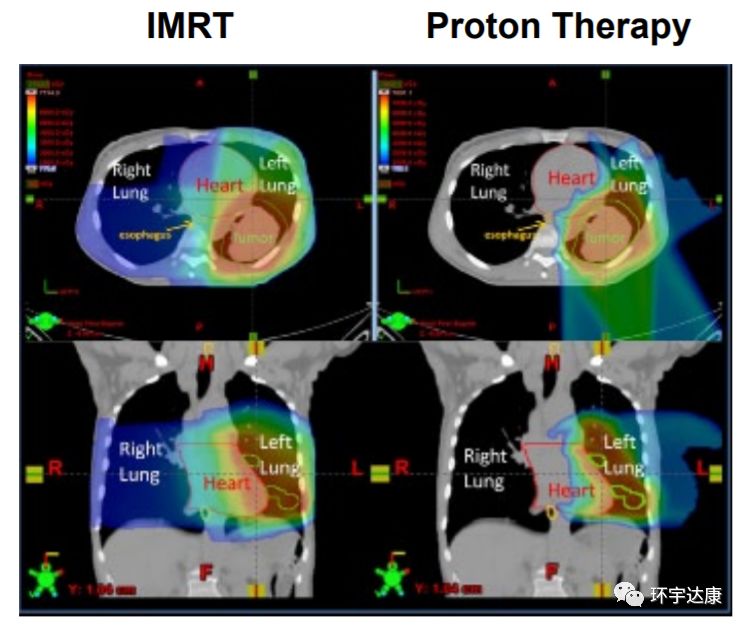 质子治疗和传统放疗对比