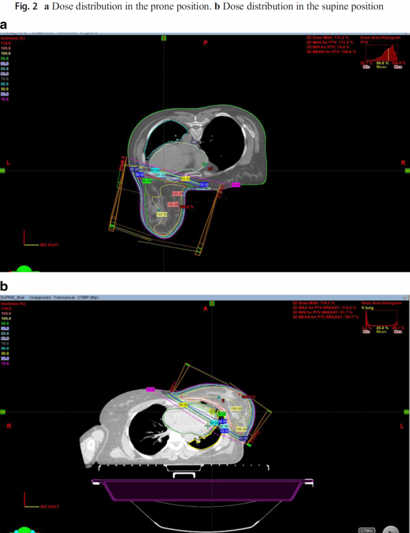 乳腺癌放疗,乳腺癌患者仰卧位与俯卧位放疗技术的剂量学比较