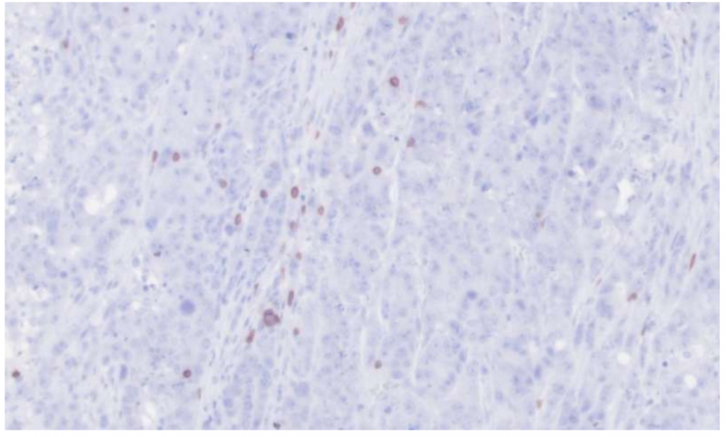 罕见细菌为前列腺癌免疫治疗指明新方向