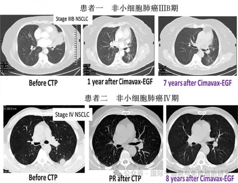 肺癌复发的原因找到了,六大肺癌预防复发的措施助您降低癌细胞"卷土重来"风险