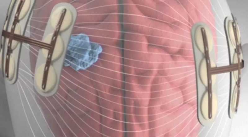 胶质母细胞瘤治疗,三大强效抗癌技术联手!脑瘤患者生存期或将再翻一倍!