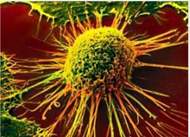 科学家发现肾癌治疗新靶点