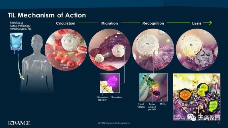 鼻窦黏膜黑色素瘤TIL免疫治疗让患者回归正常生活