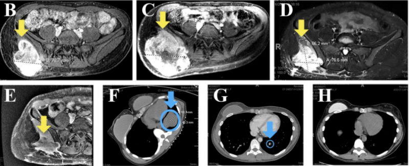 硫酸拉罗替尼胶囊疗效,16公分巨大肿瘤完全清除,肺转移消失,这款传奇抗癌药拉罗替尼临床试验招募正在进行中