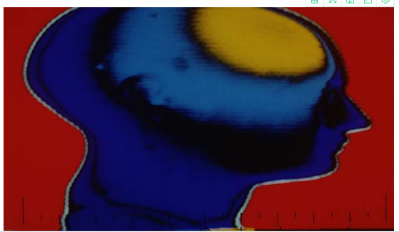 白血病化疗可能造成神经认知风险