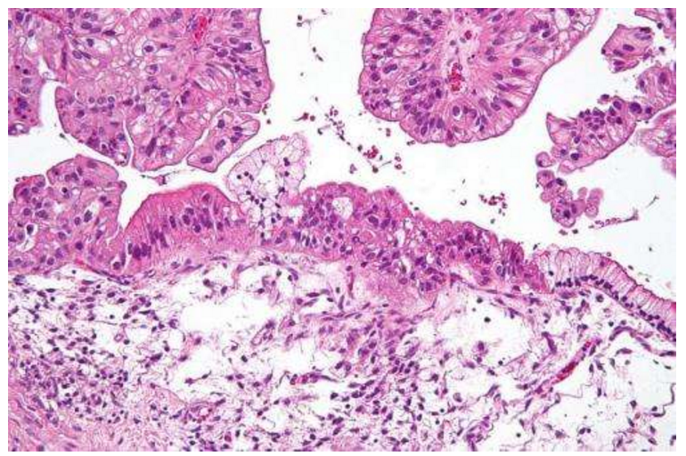 研究发现：小分子药物可以抑制卵巢癌关键诱癌基因
