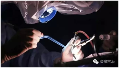 德国荧光示踪技术  可更彻底切除脑胶质瘤