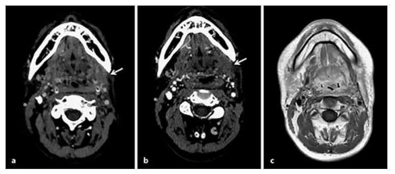 首例报道|opdivo联合伊匹单抗治疗头颈癌首获成功！
