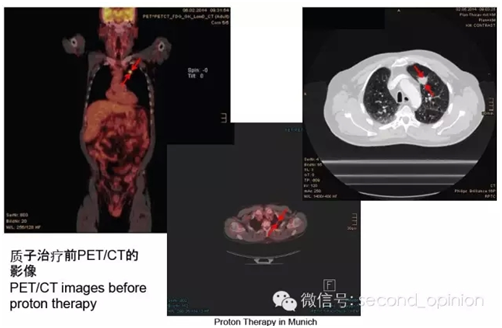德国慕尼黑质子中心治疗肺癌