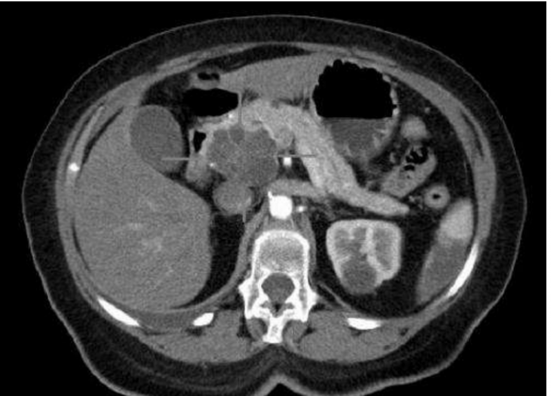 癌王胰腺癌有望很早期就被发现