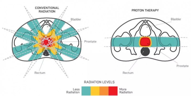 前列腺癌质子治疗,前列腺癌质子治疗的优势