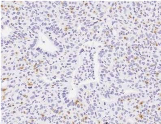 白介素能协同对抗癌症——胰腺癌